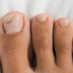 grzybica na dużym palcu u stopy